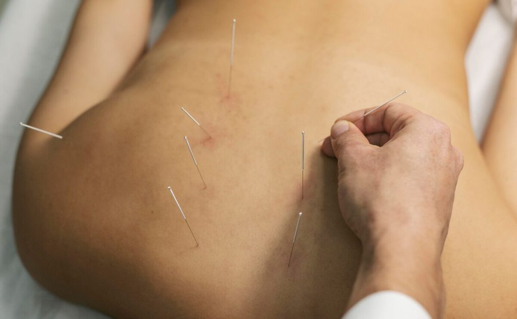 Acupuncture : est-ce une solution à la douleur chronique ?